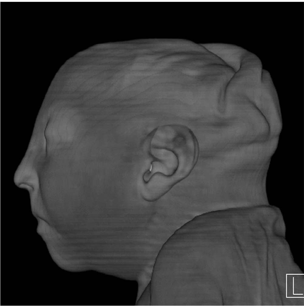 zika brain after birth