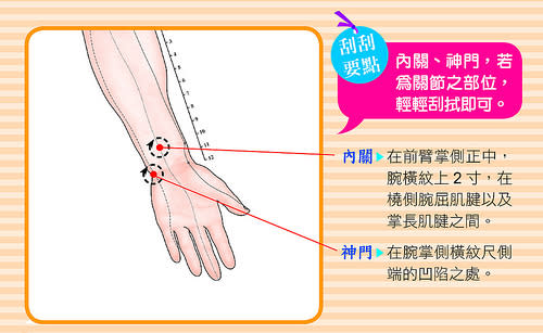內關、神門，若為關節部位，輕輕刮拭即可。