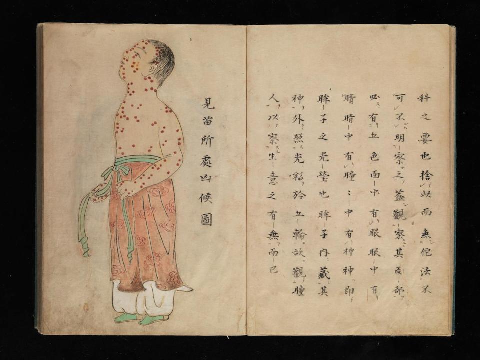 Scan of yellowed book pages with a picture of a person covered in smallpox blisters on the left page and Japanese text on the right page