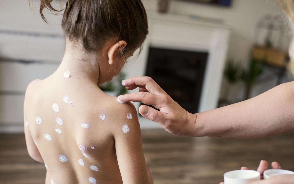 Treating chickenpox