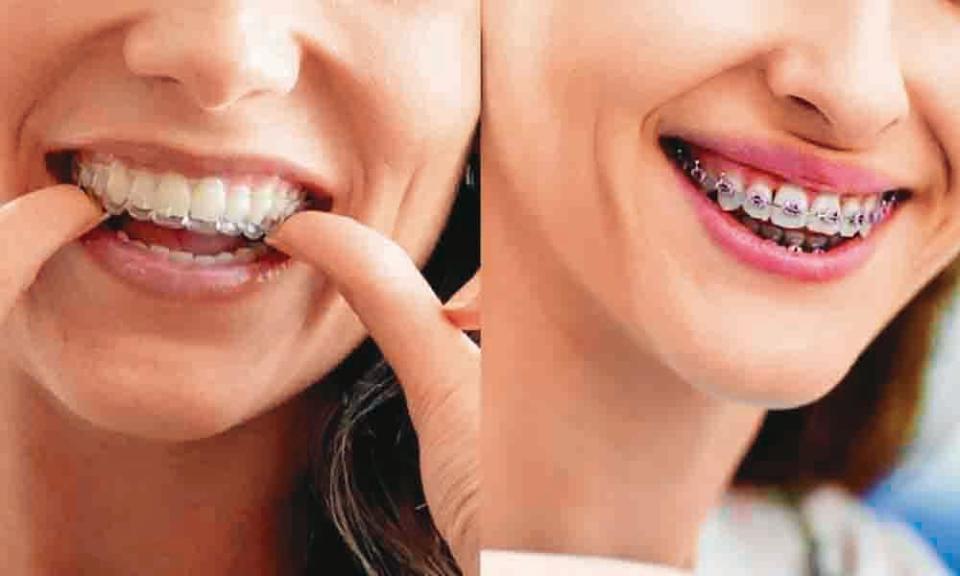 有別於傳統矯正的大鋼牙（右），隱形牙套（左）因美觀、可攜，成為這波數位牙科趨勢下的大亮點。（翻攝台北市社區營造中心）