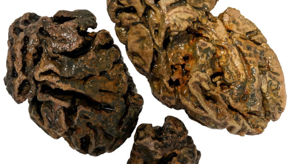 Brain fragments from a person buried in the graveyard of a Victorian almshouse in Bristol, England, around 200 years ago.  No other soft tissue survived among the bones, which were dredged from a heavily submerged grave.  - Alexandra L. Morton-Hayward