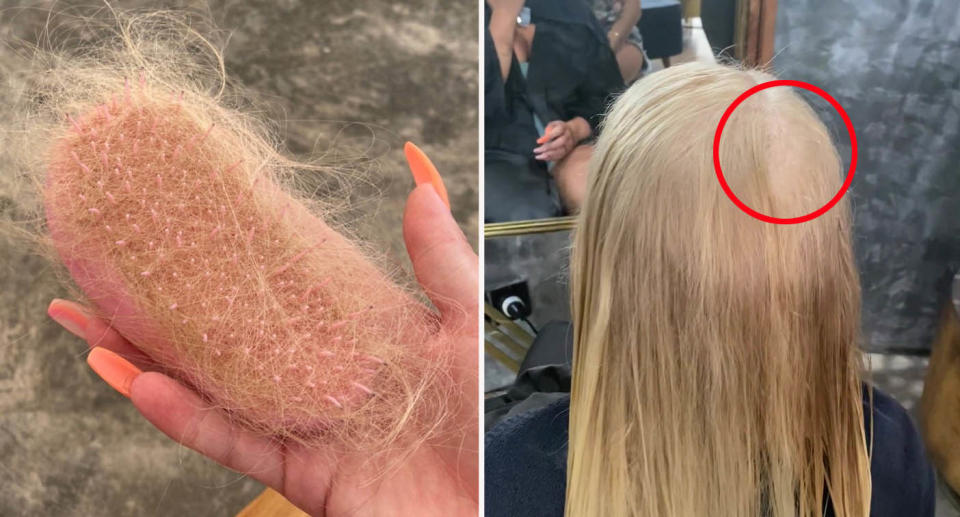 Left: Chunks of blonde hair stuck in hair brush. Right: Hollie Marie at hairdressers with bald patches. 