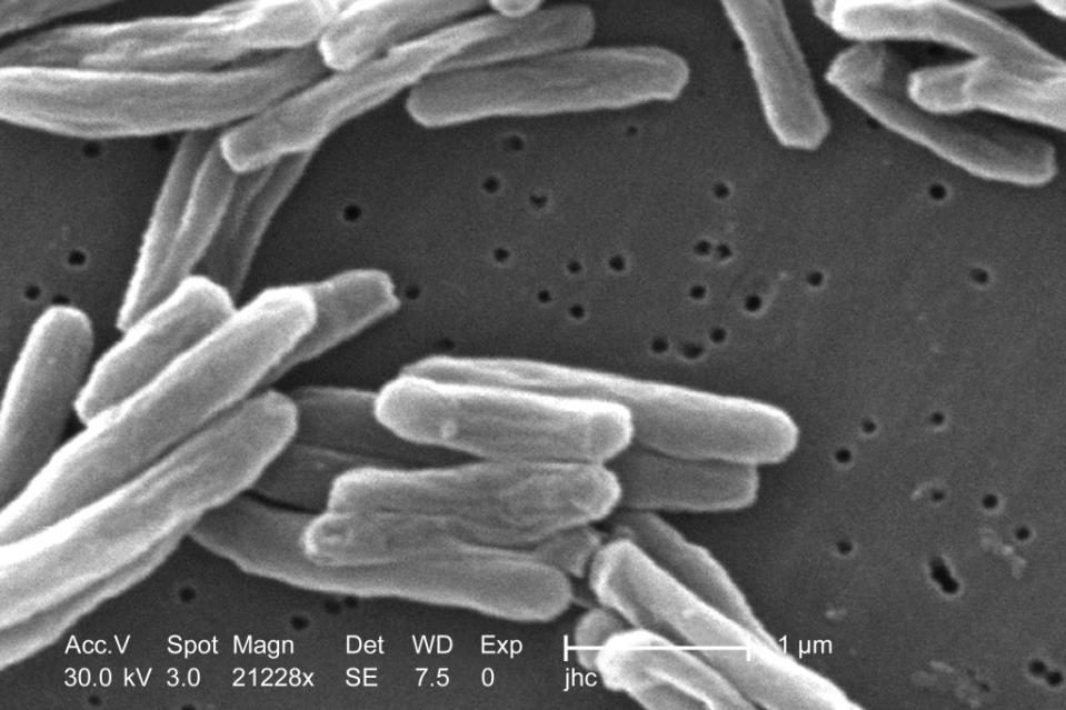 The number of U.S. tuberculosis cases in 2023 was the highest in a decade, according to a new government report. AP