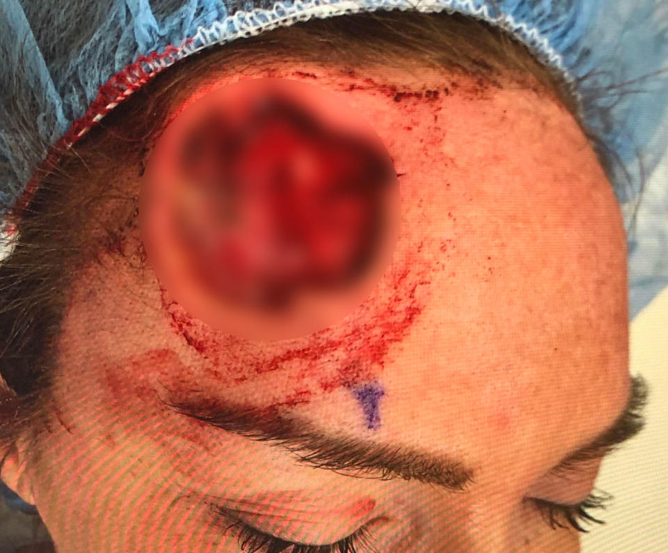 Keri Lynn Noble, 29, had to have cancerous cells removed from her forehead due to excessive exposure to sunlight.