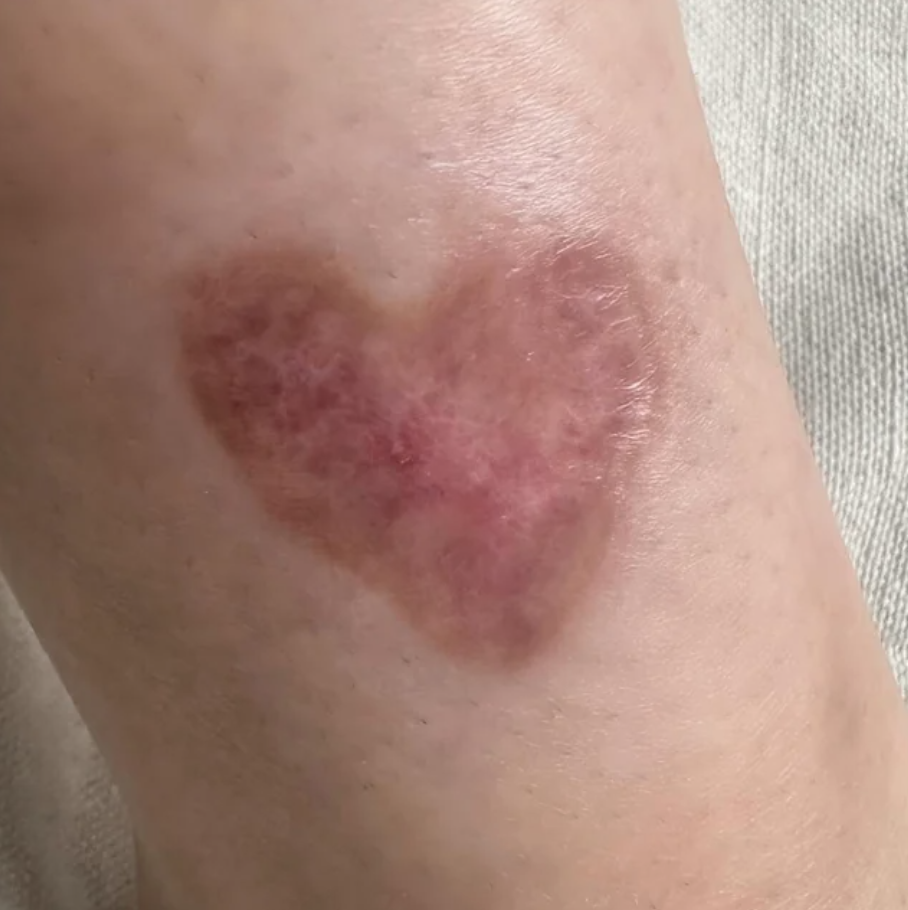 A heart-shaped scar