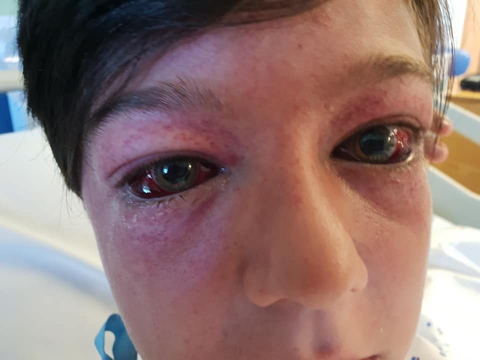 Tyler Broome, 11 from Nottingham, suffered bulging red eyes and spots known as G-measles after suffering high G-force during a stunt on a roundabout: SWNS