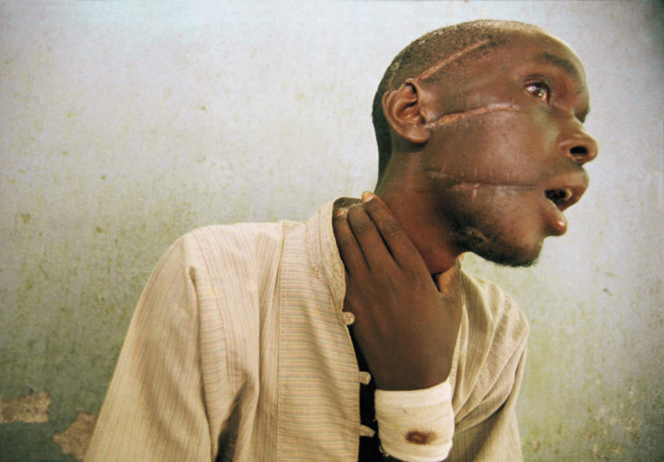FILE - Nyabimana (first name unknown), 26, who was evacuated after being found by the Red Cross wandering in Kabgayi, about 15 miles southwest of the capital Kigali, shows machete wounds at an International Committee of the Red Cross hospital in Nyanza, about 35 miles southwest of Kigali, in Rwanda, June 4, 1994. (AP Photo/Jean-Marc Bouju, File)