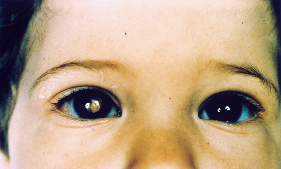 A child with retinoblastoma (Alamy/PA)
