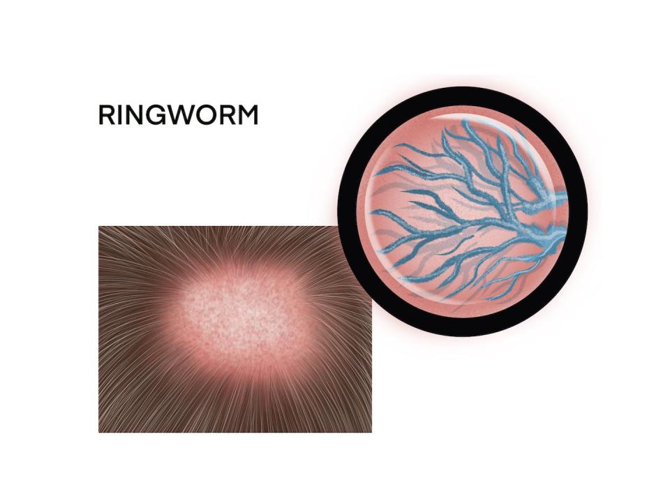 Ringworm commonly affects the scalp area and can cause hair loss. <a href="https://www.gettyimages.com/detail/illustration/medical-illustration-of-ringworm-of-the-royalty-free-illustration/1293052667?phrase=ringworm" rel="nofollow noopener" target="_blank" data-ylk="slk:Viktoriya Kabanova/iStock via Getty Images Plus;elm:context_link;itc:0;sec:content-canvas" class="link ">Viktoriya Kabanova/iStock via Getty Images Plus</a>