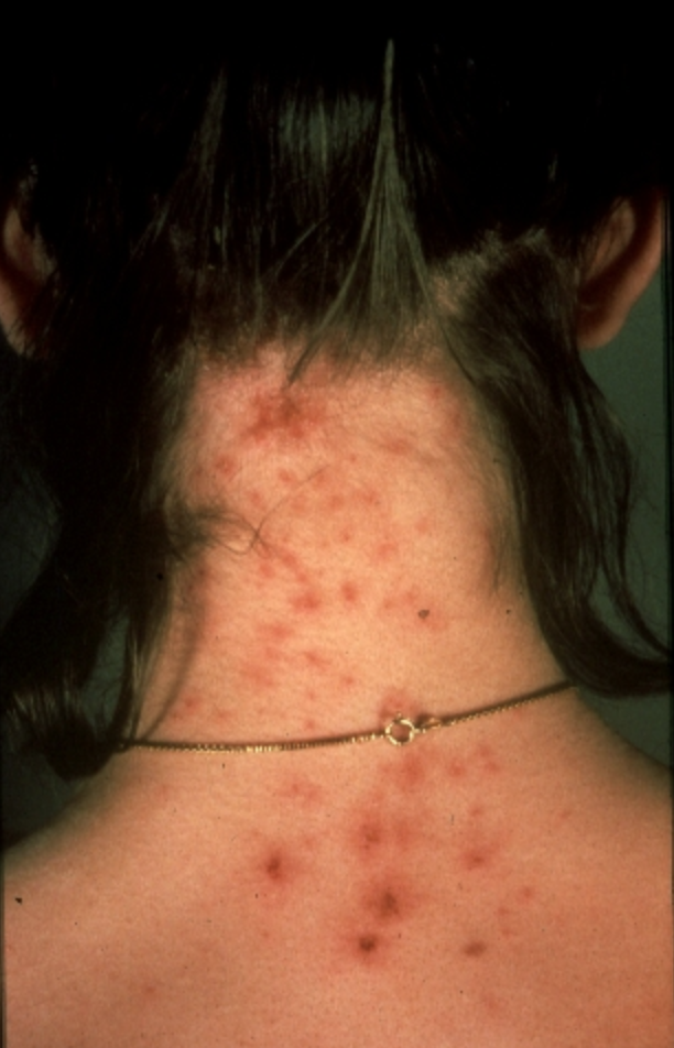 <p><strong>What they look like:</strong> Another too-close-for-comfort pest are <a href="https://www.prevention.com/health/a29476423/lice-bite-pictures/" rel="nofollow noopener" target="_blank" data-ylk="slk:head lice;elm:context_link;itc:0;sec:content-canvas" class="link ">head lice</a>, which leave patches of red, abraded spots on the scalp and surrounding skin (like this one pictured). Although their bites are small, the body’s reaction to them makes them grow. You might not even <a href="https://www.prevention.com/health/a29551102/eyelash-lice-causes/" rel="nofollow noopener" target="_blank" data-ylk="slk:see the bites;elm:context_link;itc:0;sec:content-canvas" class="link ">see the bites</a> first—the initial giveaway might be tiny lice eggs (a.k.a. nits) first.</p><p><strong>Symptoms to note:</strong> Lice bites are quite itchy, and an infestation can even feel like something is moving or tickling in the hair (which, to be honest, is what’s happening). This can actually cause trouble sleeping. Sores caused by scratching can also develop easily. The only solution is <a href="https://www.prevention.com/health/a29441468/how-to-get-rid-of-lice/" rel="nofollow noopener" target="_blank" data-ylk="slk:getting rid;elm:context_link;itc:0;sec:content-canvas" class="link ">getting rid</a> of the bugs ASAP.</p><p><strong>Related: <a href="https://www.prevention.com/health/a29503942/lice-symptoms/" rel="nofollow noopener" target="_blank" data-ylk="slk:Signs of Head Lice You Shouldn’t Ignore;elm:context_link;itc:0;sec:content-canvas" class="link ">Signs of Head Lice You Shouldn’t Ignore</a></strong></p>