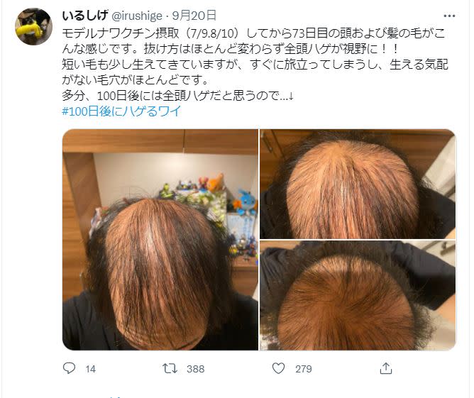 日本一名男網友打完疫苗後開始莫名其妙的掉髮。（圖／翻攝自@irushige推特）