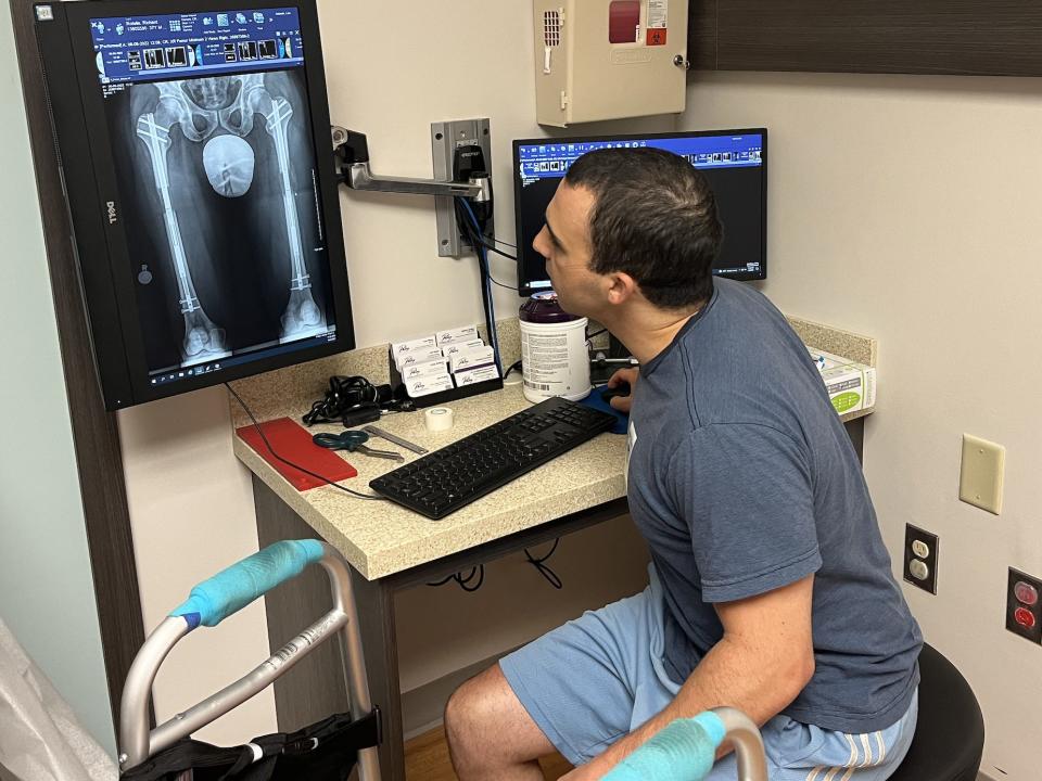 Rich Rotella looking at an X-ray of himself after his surgery.