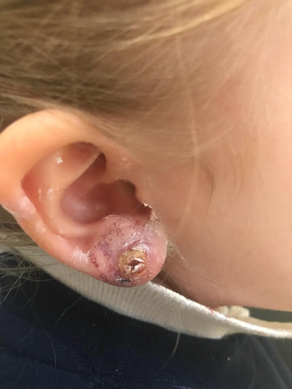 Amelia’s ear was left bloody and blistered (Mercury)