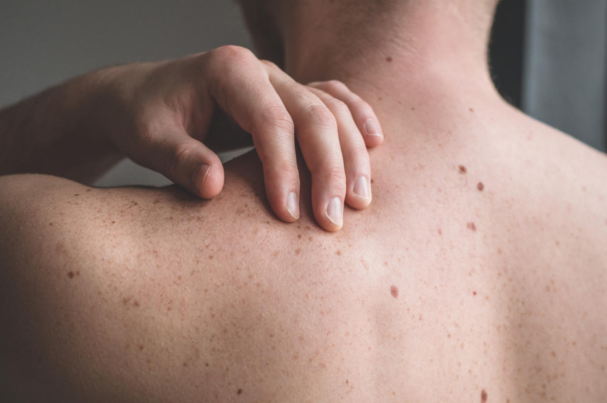 Checking benign moles. Close up detail of the bare skin on a man back with scattered moles and freckles. Sun effect on skin. Birthmarks on skin