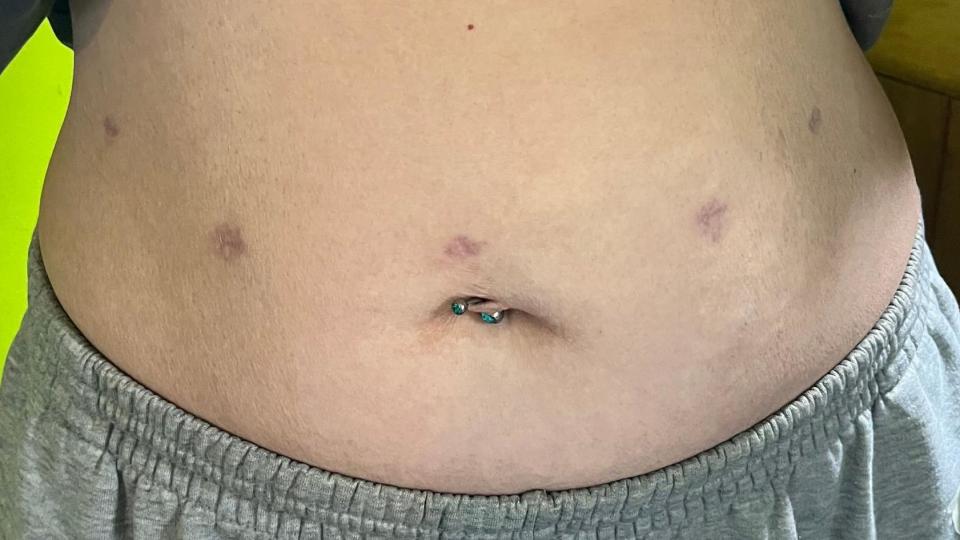 Stomach of patient showing five keyhole scars