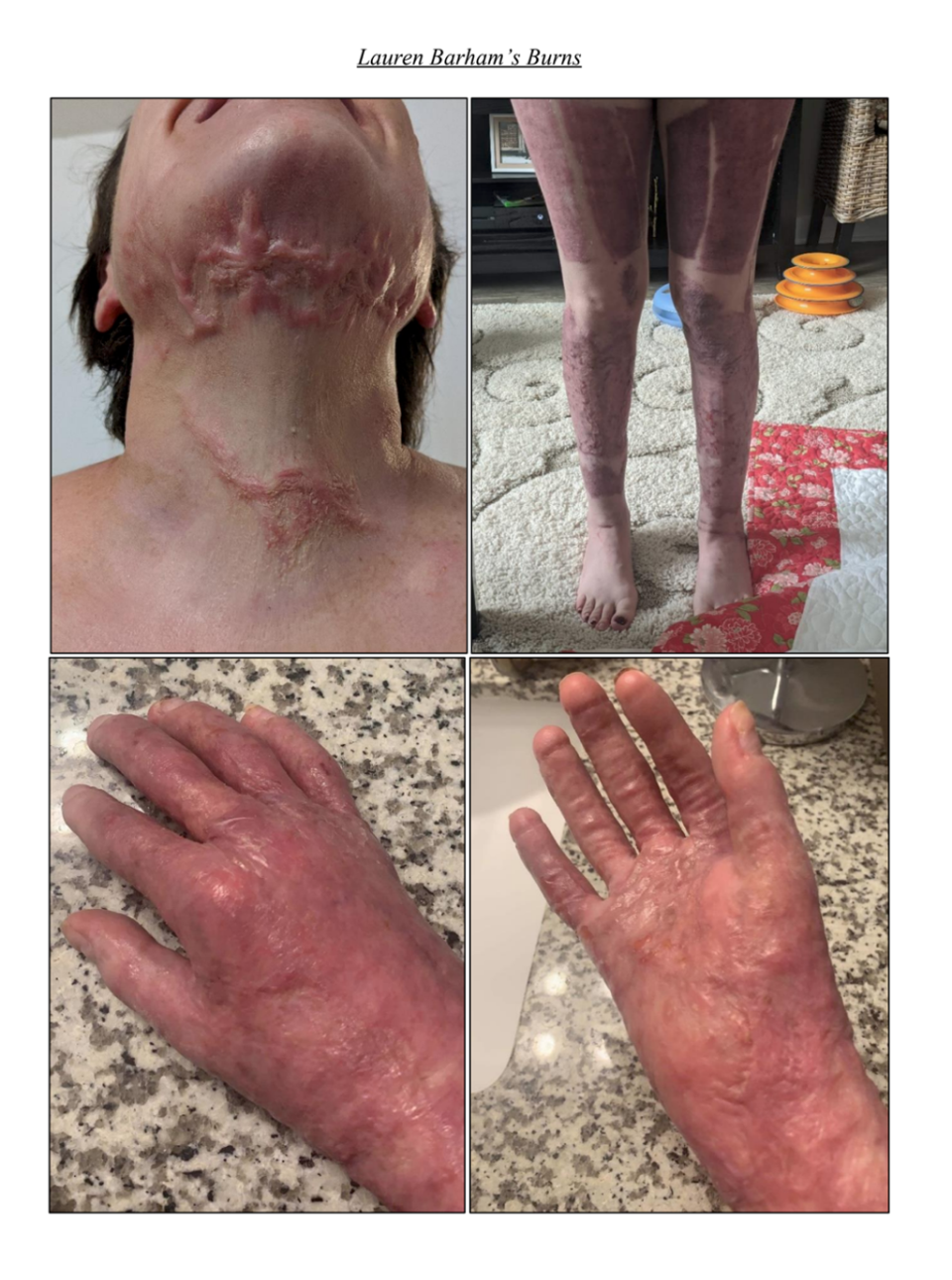 Lauren Barham sustained third degree burns to her neck legs and hands (Courtesy of Mike Winkleman)