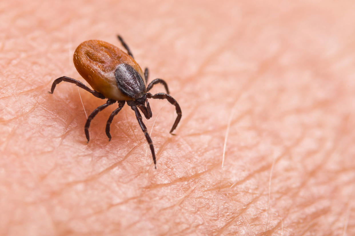 Infected female deer tick on hairy human skin. (Ladislav Kubeš / Getty Images/iStockphoto)