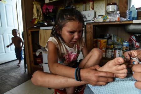 One of Beatrice Lookinghorse's grand daughters has a splinter removed from her foot at her home on the Cheyenne River Reservation in Green Grass, South Dakota, U.S., May 29, 2018. REUTERS/Stephanie Keith