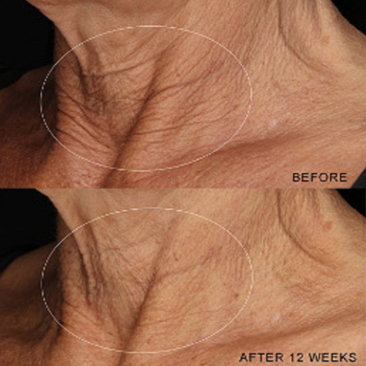 The results of a 12-week trial of the Dermalogica Neck Fit Contour Serum