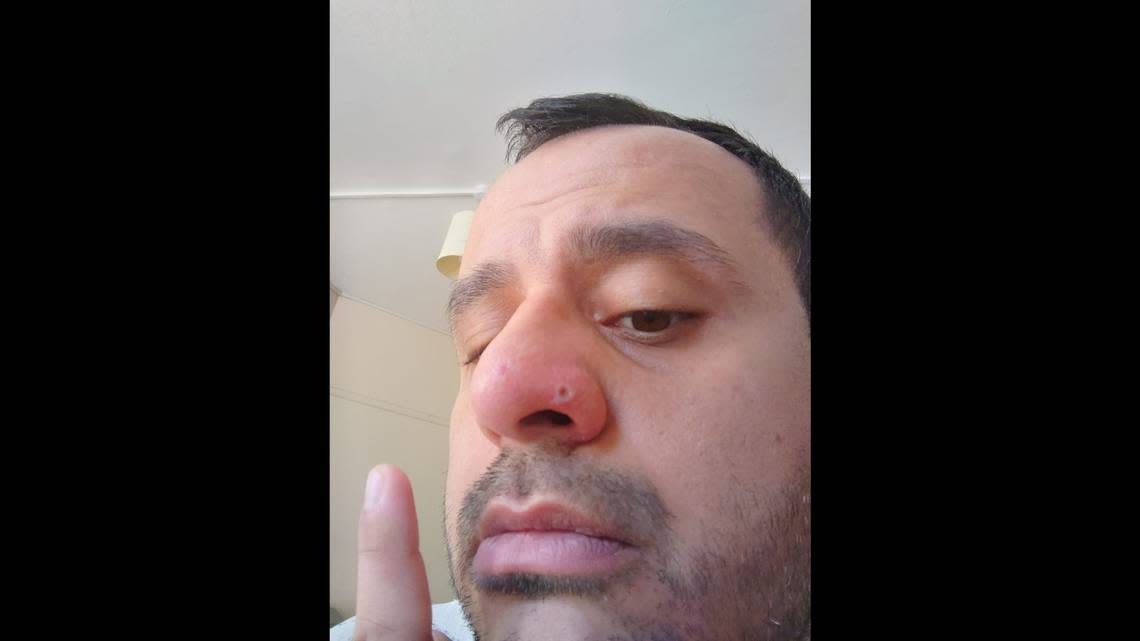 Harun Tulunay’s nose lesion from monkeypox is seen forming.