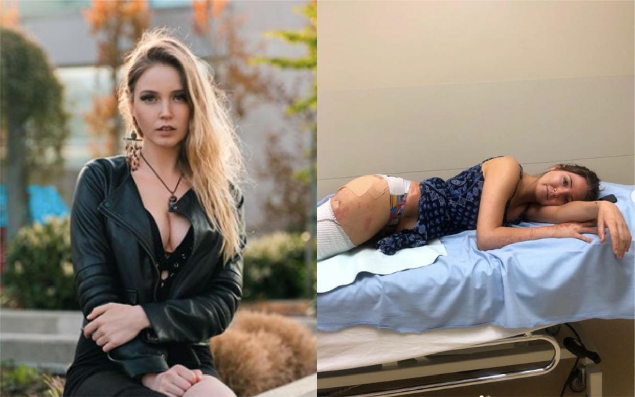 Freelance model Robyn-Lee Jansen was left with first and second-degree burns after the failed photoshoot. Photo: Instagram