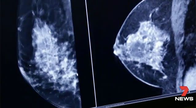 Breast density appears white and solid in mammograms and can often mask lesions. Source: 7 News