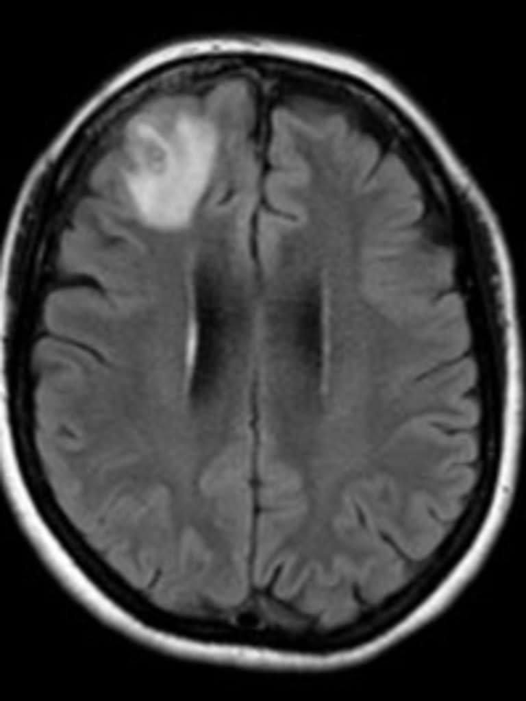 The parasite was discovered after exploration of an abnormality detected in the woman's brain via MRI. Picture: ANU