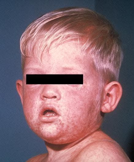 Face of boy after three days with measles rash.