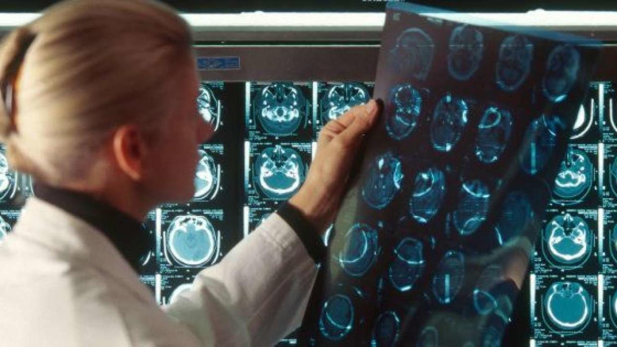 Un médecin examine les résultats d’un scanner d’une victime d’un AVC (Photo d’illustration).