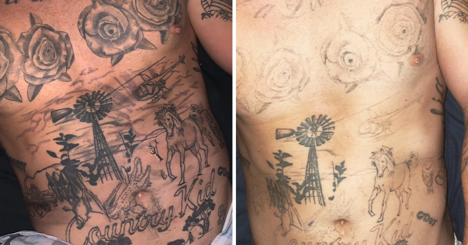 MAFS' Ryan Gallagher before and after his tattoo removal.