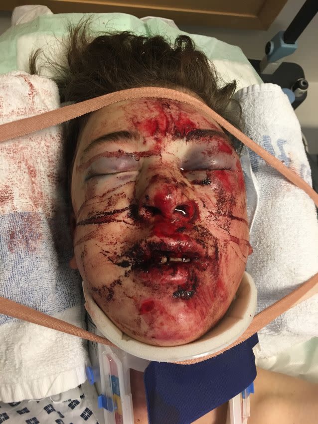 Six metal plates were inserted into Brady's face.  Source: SWNS/Mega