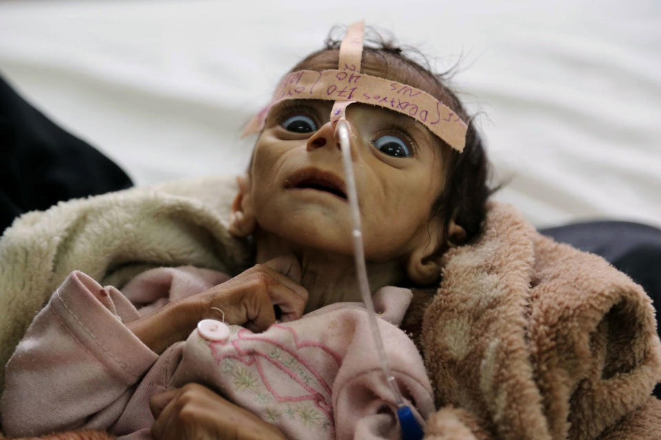 Malnutrition in Yemen