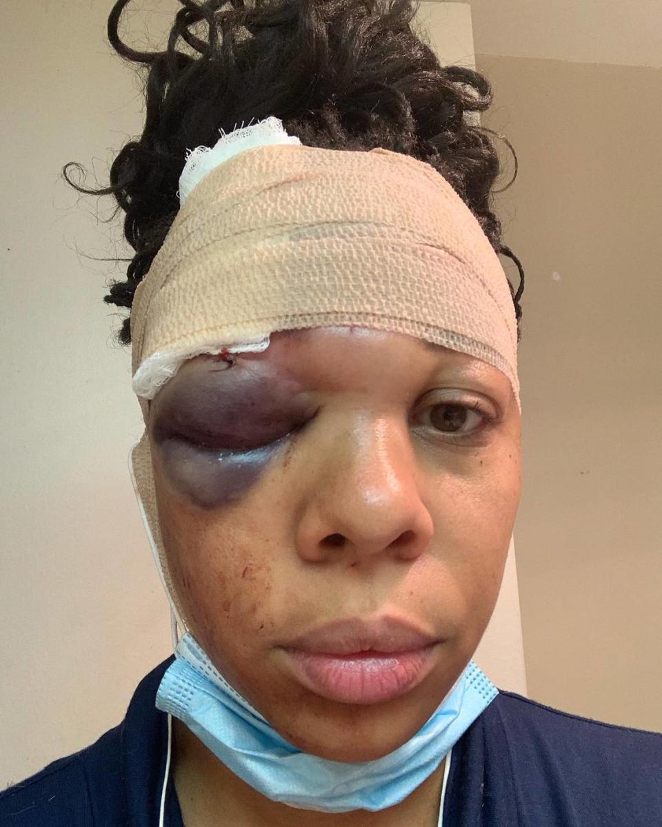 Police shot LaToya Ratlieff with a foam projectile as she stumbled away choking from tear gas at a protest in Fort Lauderdale. Her orbital socket was fractured.