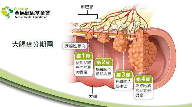 大腸癌分期圖