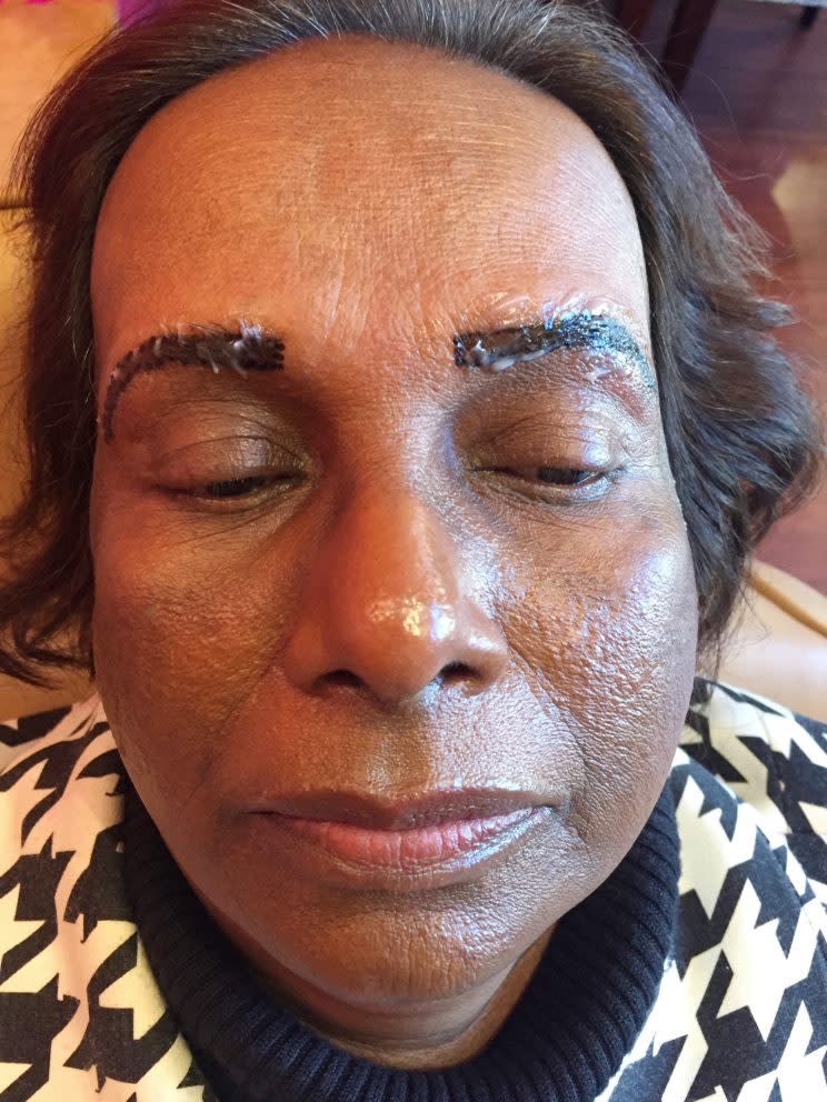 Author's mother with numbing cream on eyebrows