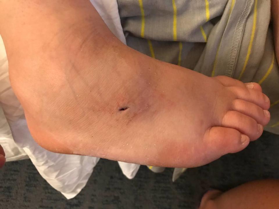 This picture shows Ashlyn Blair’s foot shortly after what lifeguards said was a stingray sting Wednesday, June 13, 2018, on Hilton Head Island, S.C.