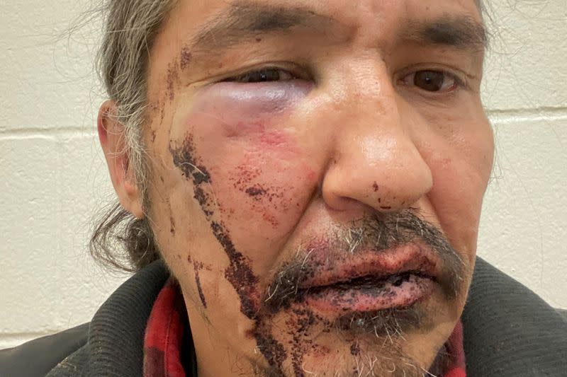 Chief Allan Adam of Athabasca Chipeywan First Nation displays his wounds that he says were caused by the RCMP