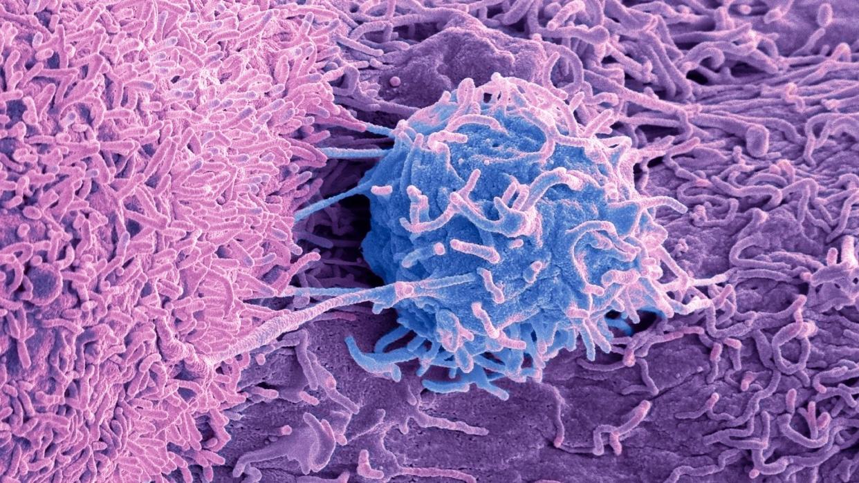  microscopic image shows a prostate cancer cell, depicted in purplish blue, against a pink background of other cells 