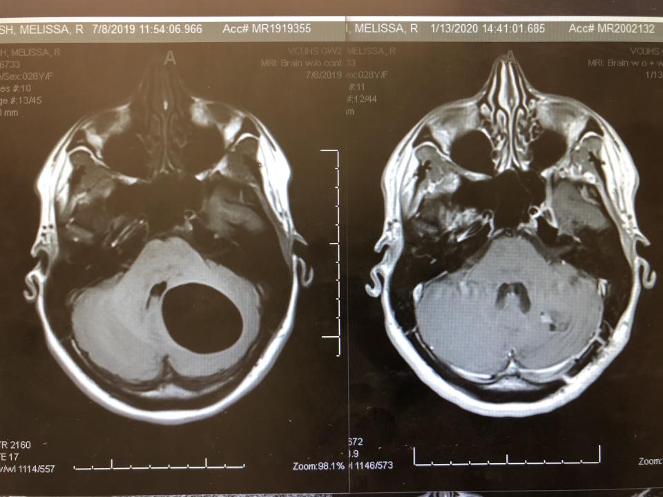 Melissa Lesh's post-surgery MRI