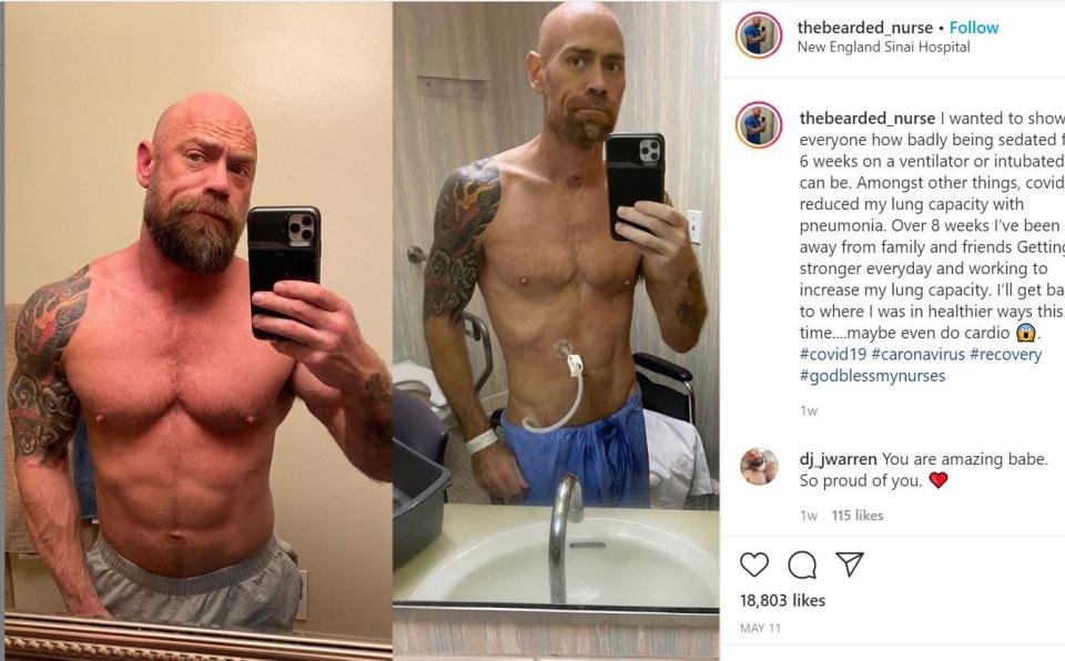 Mike Schultz told BuzzFeed News he was in the hospital for six weeks as he fought the coronavirus and lost at least 50 pounds.