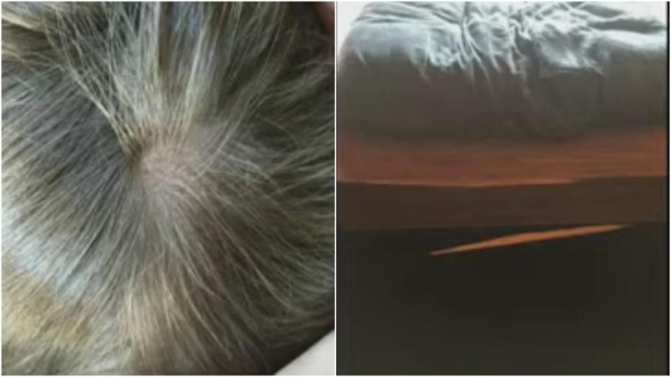 <div class="inline-image__caption"><p>Images allegedly showing a chunk of Heard’s hair missing (left) and the broken bed (right).</p></div> <div class="inline-image__credit">Fairfax County Circuit Court</div>