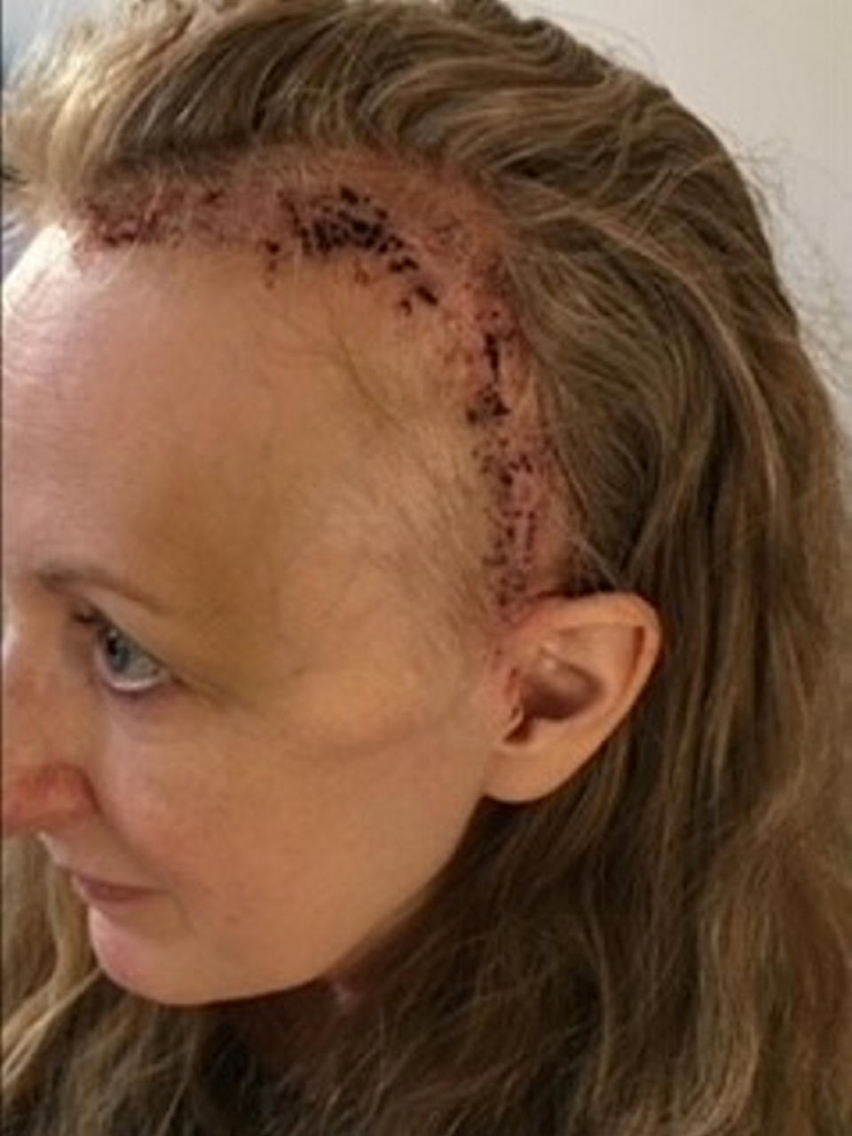 Wheatley pictured following surgery. (Brain Tumour Research/SWNS)