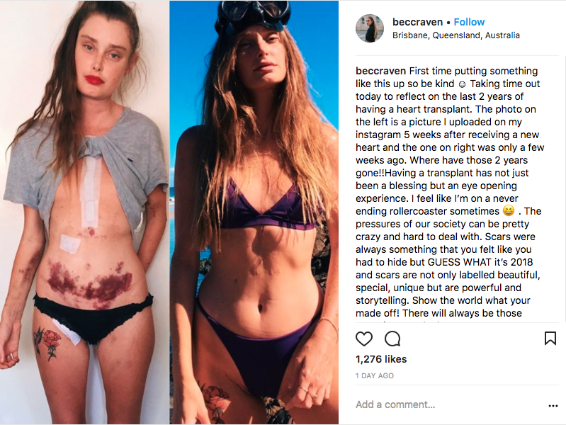 Bec shared a powerful side-by-side with her followers. Photo: Instagram