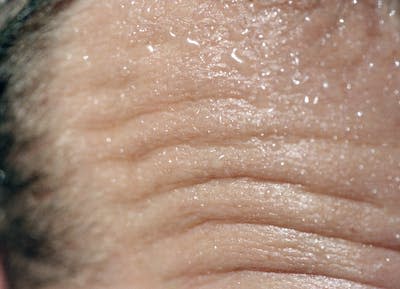 Sweating is one way the body stays cool. In heat stroke, sweating stops, leaving the body in danger of fatally overheating. <a href="https://www.gettyimages.com/detail/photo/close-up-of-mans-wrinkled-forehead-royalty-free-image/200390293-001" rel="nofollow noopener" target="_blank" data-ylk="slk:Veronique Beranger/The Image Bank via Getty Images;elm:context_link;itc:0;sec:content-canvas" class="link ">Veronique Beranger/The Image Bank via Getty Images</a>
