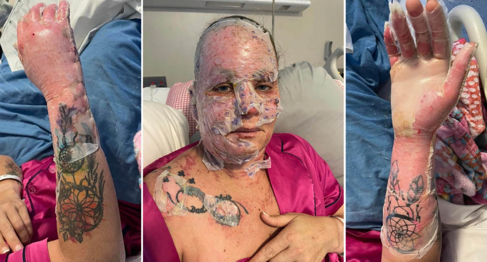 Anita Ferguson in hopsital with artificial skim after fire pit explosion left her with second-degree burns on face, neck and arm. 