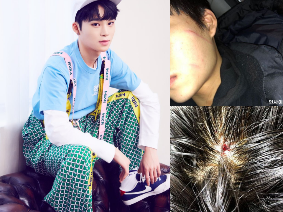 MASC前成員CHIBIN在IG自爆被成員毆傷，臉頰與頭頂都有傷口。（翻攝自網路）