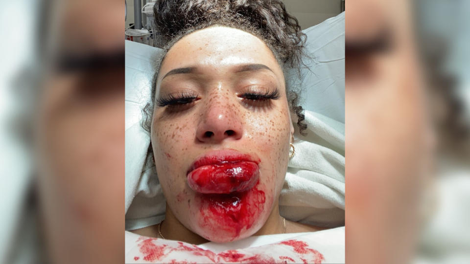 Amara Green took this selfie at an emergency room in Minneapolis about an hour after police shot her with a rubber bullet while she was attending a protest on May 27. (Photo: Courtesy of Amara Green)