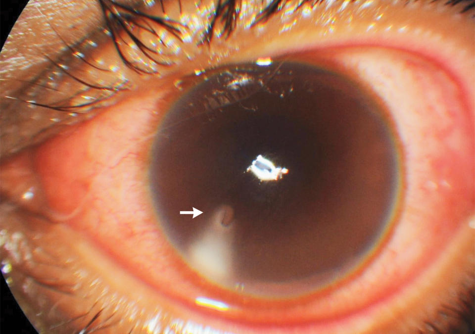 A man, 22, pictured with a bee stinger in his eye.