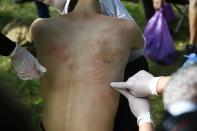 A man shows marks on his body he says were left by police beating after being released from a detention center where protesters were detained during a mass rally following presidential election in Minsk, Belarus, Friday, Aug. 14, 2020. Belarusian authorities have released more than 1,000 people detained during a violent police crackdown on protests and many talked about brutal beatings and other abuse by police. (AP Photo/Sergei Grits)